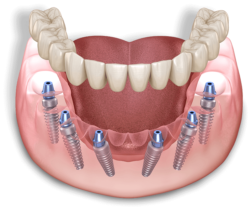 close illustration of full arch dental implants