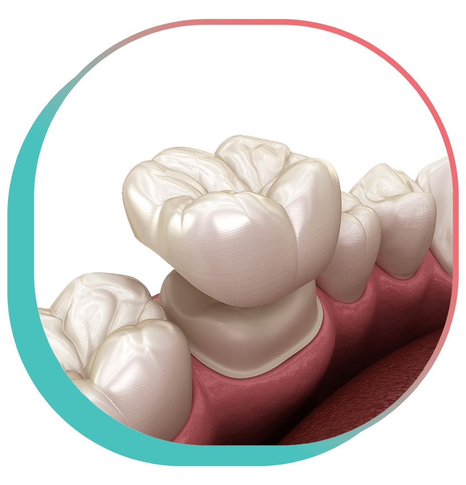 close up 3d illustration of dental crown