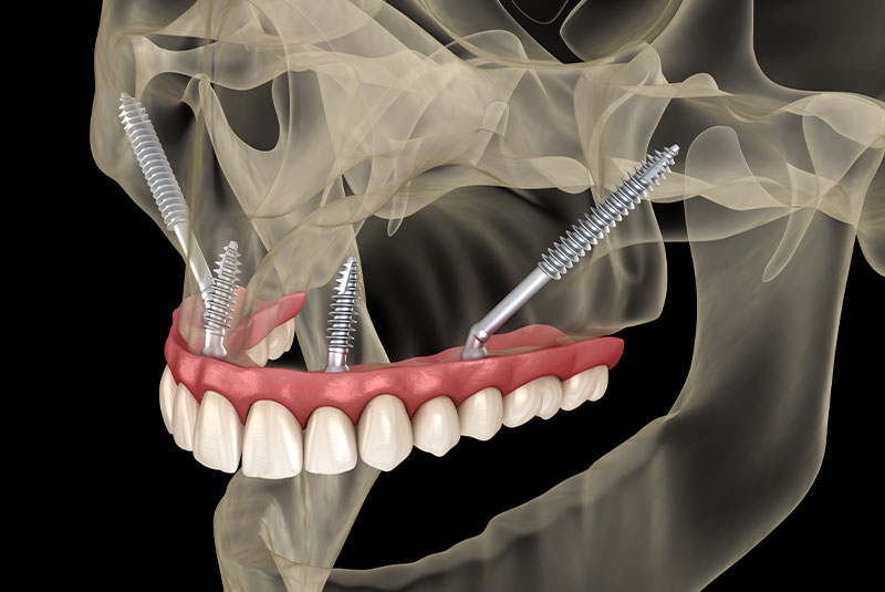 Maxillary prosthesis supported by zygomatic implants. Medically accurate 3D illustration of human teeth and dentures
