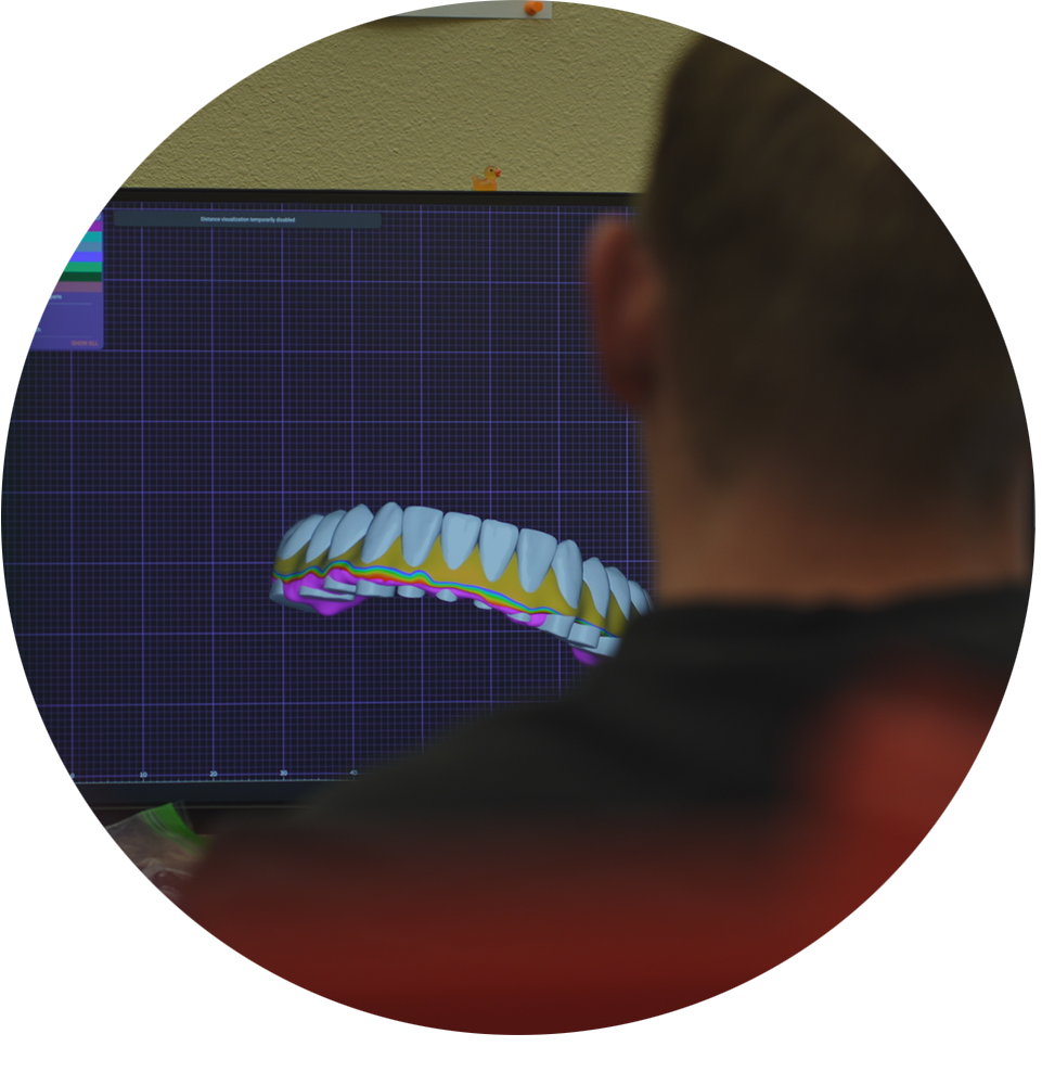 team member making a model of a full arch dental implant