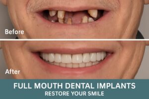 A before-and-after image showcasing a patient's smile transformation with full mouth dental implants. The "before" side shows missing and damaged teeth, while the "after" side displays a complete, natural-looking set of teeth. Text on image says "Full Mouth Dental Implants: Restore Your Smile".