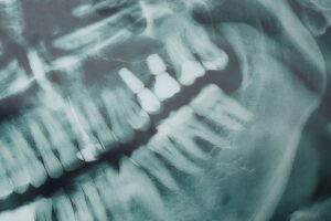 Image depicting the tooth implant procedure time phases using a visual timeline from consultation to final crown placement on a smiling patient. No text on the image.