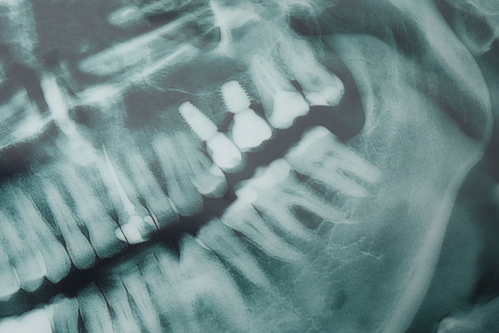 Image depicting the tooth implant procedure time phases using a visual timeline from consultation to final crown placement on a smiling patient. No text on the image.